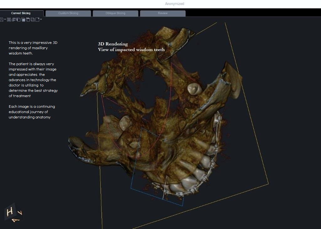 Maxillary impactions 3D rendering