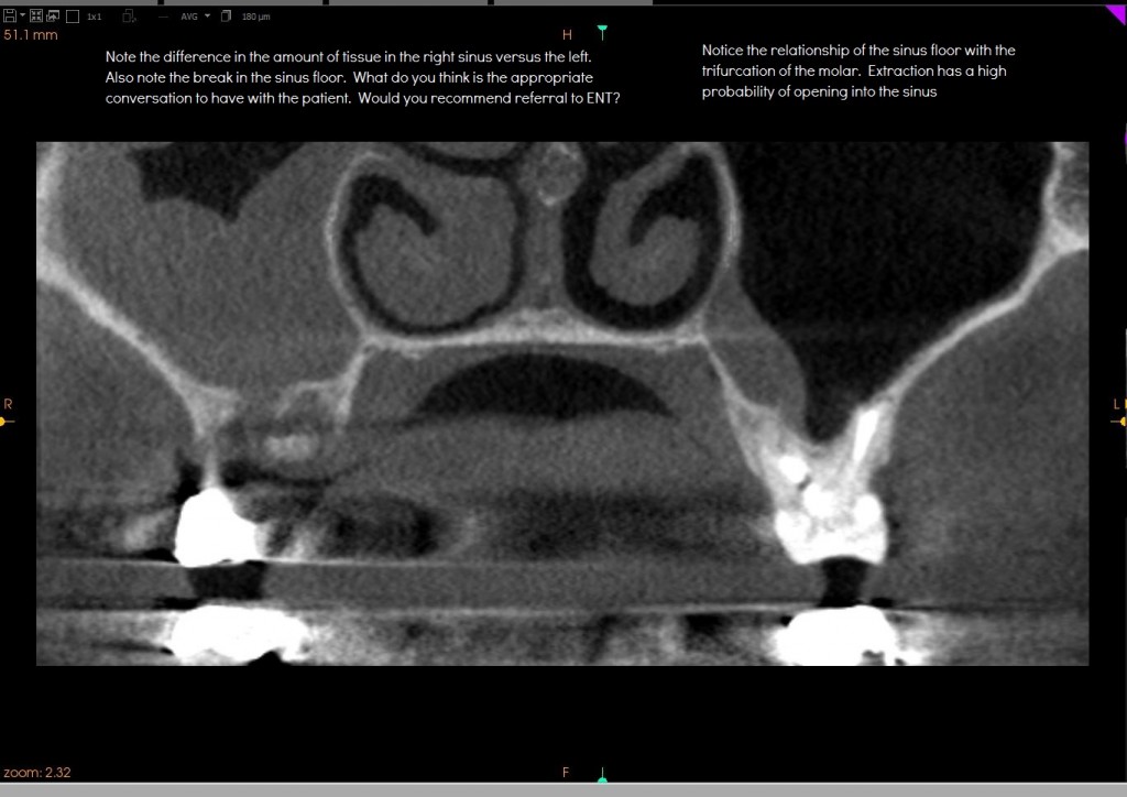 sinus blockage with perforation
